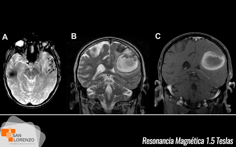 Diferencias-entre-R.M1.5T-y-R.M3T