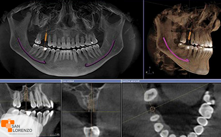 Tac-mandibula